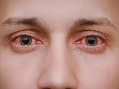 Có phải cứ đau mắt đỏ là lây cho người khác?