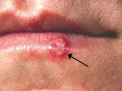 Phân biệt Herpes và nhiệt miệng
