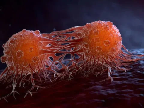 4 'thủ phạm' gây ung thư phổ biến nhất