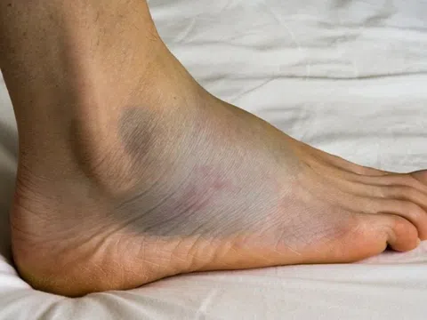 Những dấu hiệu cảnh báo suy tim dễ bị bỏ qua