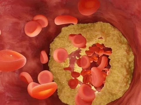 Cứ 10 người lại có 3 người mắc bệnh này